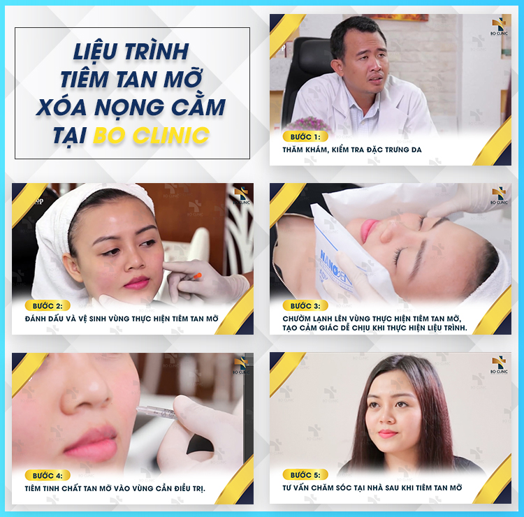 Tiêm tan mỡ thon gọn cằm tại Bo Clinic an toàn, hiệu quả nhanh chóng