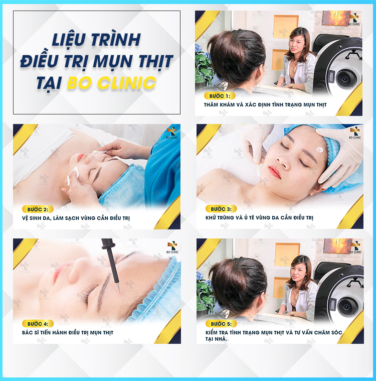 Liệu trình điều trị mụn thịt tại Bo Clinic được bác sĩ có chuyên môn thực hiện