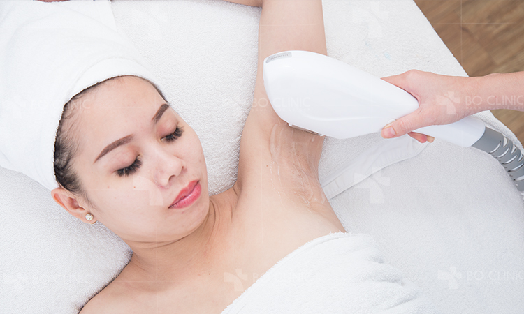 Triệt lông cơ thể công nghệ IPL