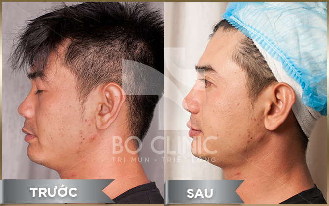 Before after thẩm mỹ mũi cằm