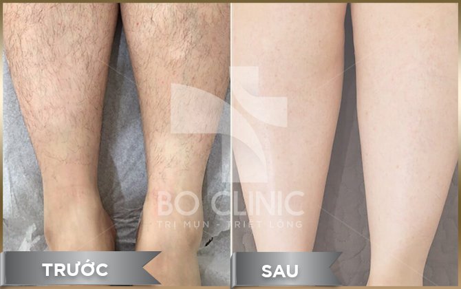 Triệt lông công nghệ IPL tại Bo Clinic