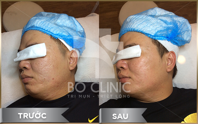 Trị sẹo lõm công nghệ Laser CO2 tại Bo Clinic