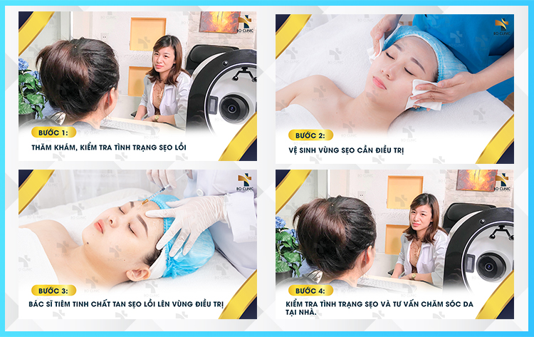 Liệu trình tiêm tan sẹo lồi tại Bo Clinic được thực hiện trực tiếp bởi bác sĩ chuyên khoa